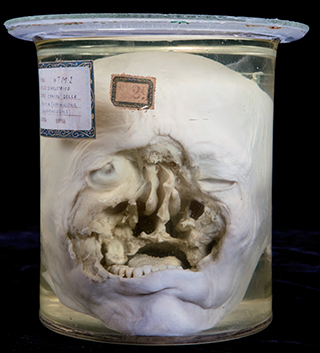 Anatomia Patologica - Granuloma gangrenescens letale del naso MOBILE
