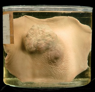 Anatomia Patologica - Carcinoma mammario
