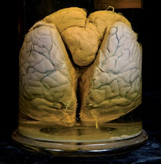 Anatomia Patologica - Glioma cerebrale