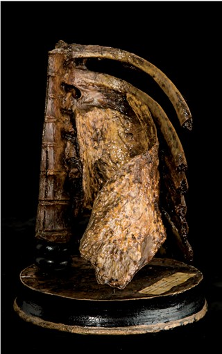 Anatomia Patologica - Pachipleurite calcifica