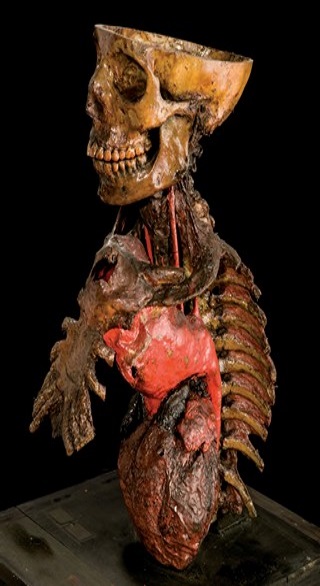Anatomia Patologica - Aneurisma sifilitico dell’aorta toracica 
