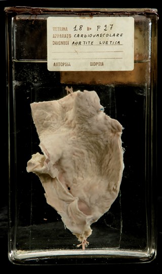 Anatomia Patologica - Aortite sifilitica
