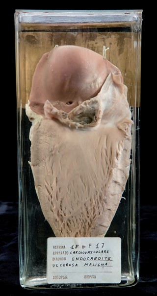 Anatomia Patologica - Endocardite ulcero vegetante di valvola aortica bicuspide ulcero-vegetative