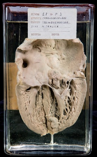 Anatomia Patologica - Valvulopatia reumatica cronica della mitrale