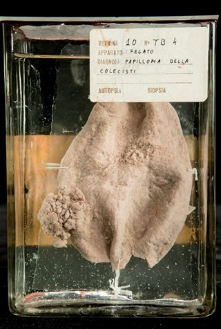 Anatomia Patologica - Papilloma della colecisti