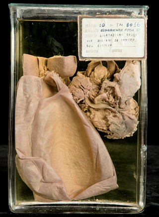 Anatomia Patologica - Idrope della colecisti