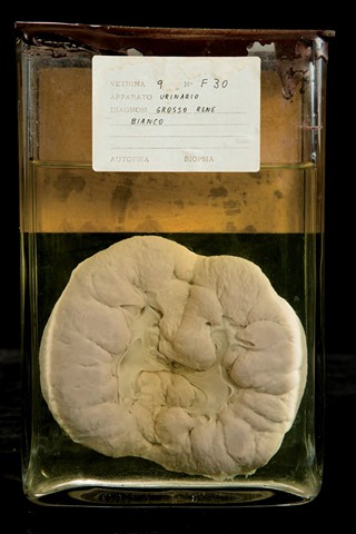 Rene amiloidotico (grosso rene bianco) Anatomia Patologica - Rene amiloidotico (grosso rene bianco)