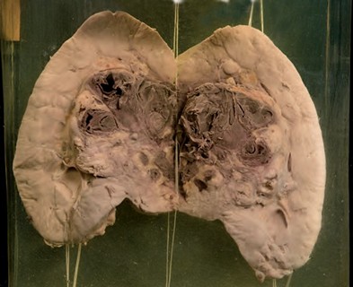 Anatomia Patologica - Carcinoma renale (tumore di Grawitz)